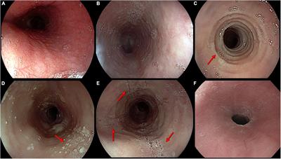 Type 2 Inflammation in Eosinophilic Esophagitis: From Pathophysiology to Therapeutic Targets